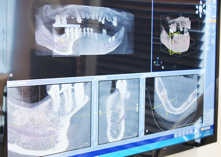 インプラント治療のシミュレーション