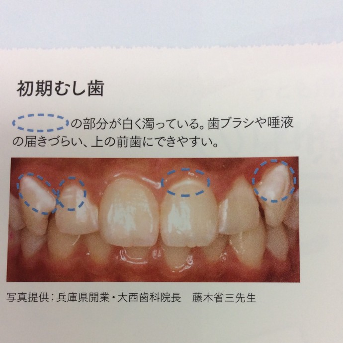 歯に白い斑点 何だろう ブログ 関内 山下町の歯医者 パークサイド横浜デンタルクリニック